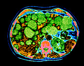 F/colour CT scan of polycystic disease in liver