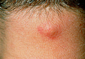 Close up: inflamed sebaceous cyst on male neck