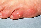 Corn (callus) on the little toe in an adult