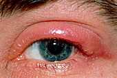 Hordeolum or stye on the upper eyelid
