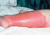 Inflammation due to cellulitis on the lower leg