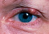 Stye (hordeolum) on patient's upper eyelid