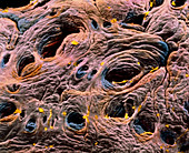 SEM of intestine,showing coeliac disease