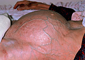 Swollen abdomen caused by constipation,geriatric