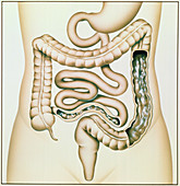Artwork of Crohn's disease and ulcerative colitis