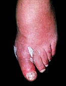 Cellulitis on the toe of a 75-year-old man