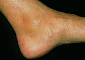 Arthropathic ankle of patient with Crohn's disease