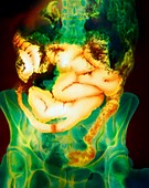 Coloured X-ray of the intestine in Crohn's disease