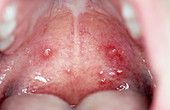 Chickenpox lesion in the mouth of a child