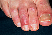 Chilblains on the toes of patient on beta blockers