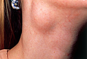 Close-up of a branchial cyst in neck of a woman
