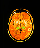 Coloured MRI scan of human brain diseased with CJD