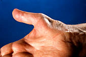 Thumb muscle wasting due to carpal tunnel syndrome