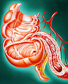 Artwork of Crohn's disease of the small intestine