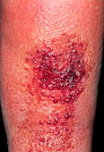 Cellulitis on a woman's leg after an insect bite