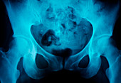 X-ray of a pelvis showing dermoid cyst with tooth