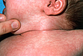 Close up of baby's neck with sternomastoid cyst