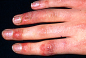 Chilblains on the fingers of a 16 year old girl