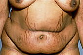 Stretch marks caused by Cushing's syndrome