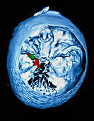 Coloured 3-D MRI scan of a brain cyst