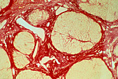 LM of liver tissue showing cirrhosis
