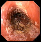 Oesophageal thrush