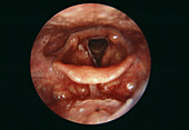 Candidiasis of larynx