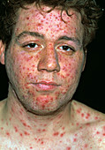 Chickenpox blisters on face