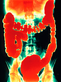 Crohn's disease,coloured X-ray