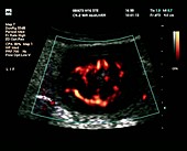 Crohn's disease,Doppler ultrasound