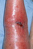 Leg laceration and cellulitis