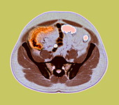 Crohn's disease,MRI