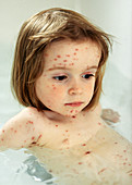 Young girl with chickenpox