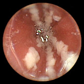 Oesophageal candidiasis,pill camera view