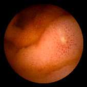 Ulcer in Crohn's disease,pill camera
