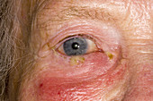 Orbital cellulitis