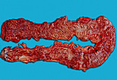 Ulcerative colitis,after colectomy