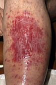 Cellulitis