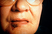 Cancer (squamous cell) of the lower lip