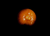 Endoscope image of rectal cancer