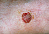 Squamous cell cancer of skin on leg
