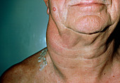 Non-Hodgkin's lymphoma: neck lymphadenopathy