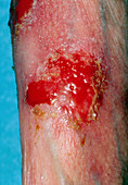 Mycosis fungoides: ulcers on leg