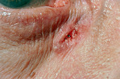 Rodent ulcer near eye