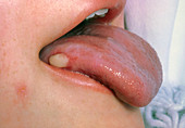Close-up of cancer of the tongue