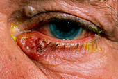 Basal cell carcinoma of lower eyelid