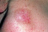 Basal cell carcinoma 3 months after radiotherapy