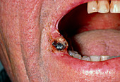 Squamous cell carcinoma of the lip in a man