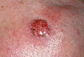 Basal cell carcinoma on a man's cheek