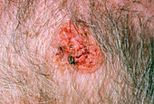 Squamous cell carcinoma on scalp